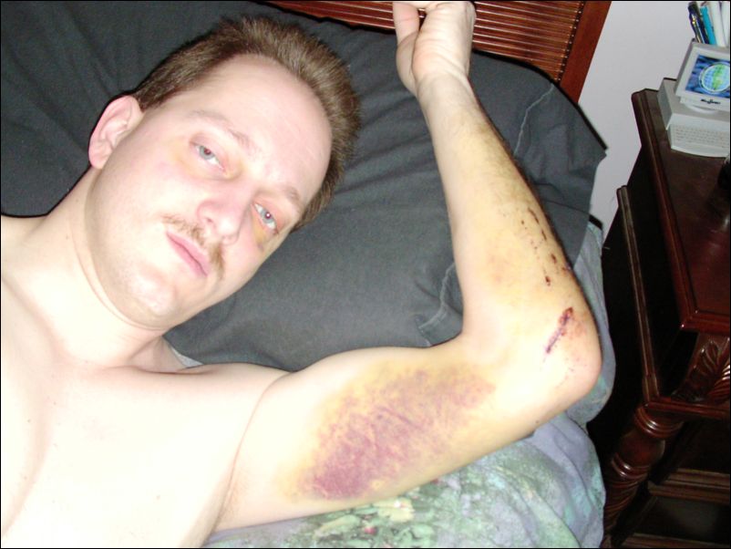 A few stiches in my left arm but nothing broken other than my nose.  Can you say VERY LUCKY!